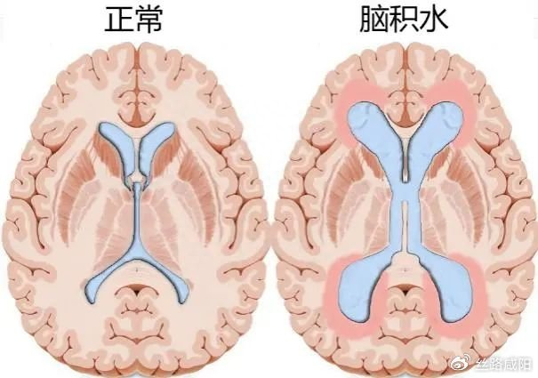 中国弱智这种智障与脑瘫去特殊学校接受特殊教育,那么外国的呢?那么脑膜炎和脑积水呢?
