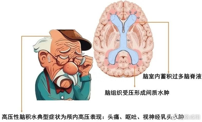 中国弱智这种智障与脑瘫去特殊学校接受特殊教育,那么外国的呢?那么脑膜炎和脑积水呢?