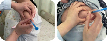 打肝素怎么拔针打完低分子肝素需要按压吗?按压多久?一文读懂_新闻资讯_第4张_活检穿刺产品网 打肝素怎么拔针打完低分子肝素需要按压吗?按压多久?一文读懂_https://www.jmylbn.com_新闻资讯_第4张