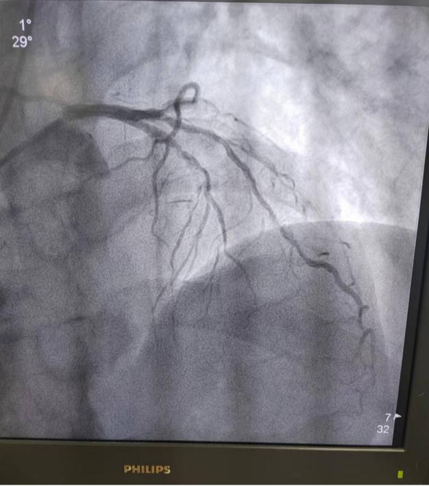 什么原因会引起血管钙化 w700d1q75cms.jpg