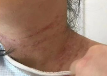 一颗滚鸡蛋，治好湿疹瘙痒、腹泻、黑眼圈！5分钟拔除夏天湿毒热毒