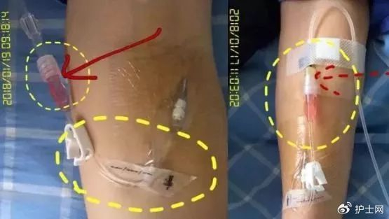 为什么输液要盖块纱布留置针肝素帽取下后,你还打算继续使用吗?_新闻资讯_第1张_活检穿刺产品网 为什么输液要盖块纱布留置针肝素帽取下后,你还打算继续使用吗?_https://www.jmylbn.com_新闻资讯_第1张