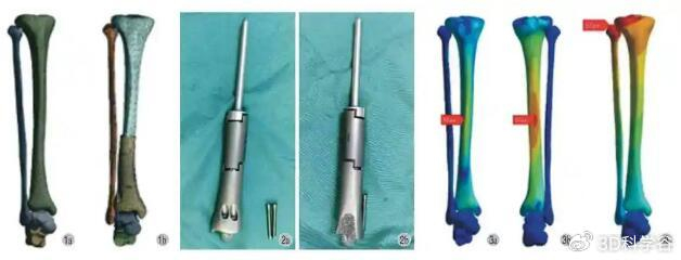 假体隆鼻后遗症有哪些 假体隆鼻老了会怎样