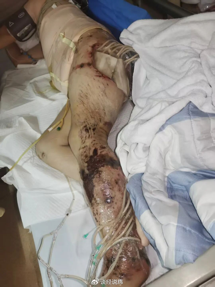 保定徐水:人社局认定工伤 获赔百万后被工地方起诉不当得利(图8)