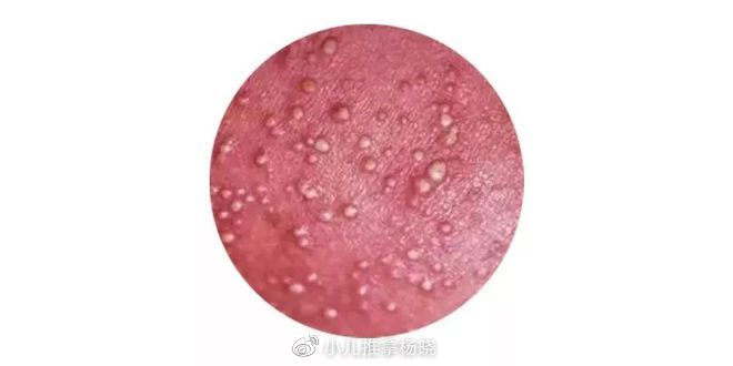 疤不得怎么用小儿推拿杨晓:夏天宝宝长痱子怎么办?如何预防护理?常见哪些误区_新闻资讯_第6张_活检穿刺产品网 疤不得怎么用小儿推拿杨晓:夏天宝宝长痱子怎么办?如何预防护理?常见哪些误区_https://www.jmylbn.com_新闻资讯_第6张