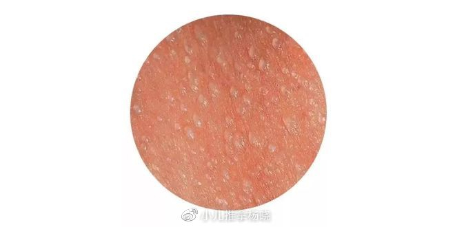 疤不得怎么用小儿推拿杨晓:夏天宝宝长痱子怎么办?如何预防护理?常见哪些误区_新闻资讯_第5张_活检穿刺产品网 疤不得怎么用小儿推拿杨晓:夏天宝宝长痱子怎么办?如何预防护理?常见哪些误区_https://www.jmylbn.com_新闻资讯_第5张