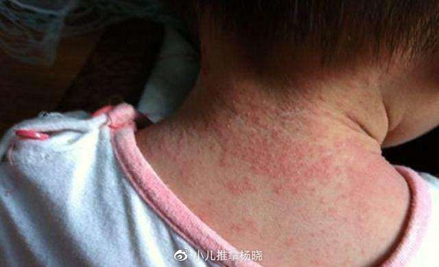 疤不得怎么用小儿推拿杨晓:夏天宝宝长痱子怎么办?如何预防护理?常见哪些误区_新闻资讯_第4张_活检穿刺产品网 疤不得怎么用小儿推拿杨晓:夏天宝宝长痱子怎么办?如何预防护理?常见哪些误区_https://www.jmylbn.com_新闻资讯_第4张