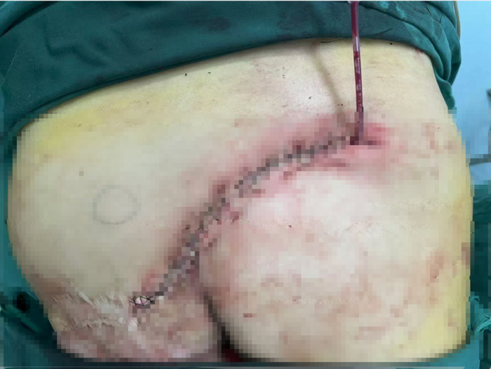 保定徐水:人社局认定工伤 获赔百万后被工地方起诉不当得利(图4)