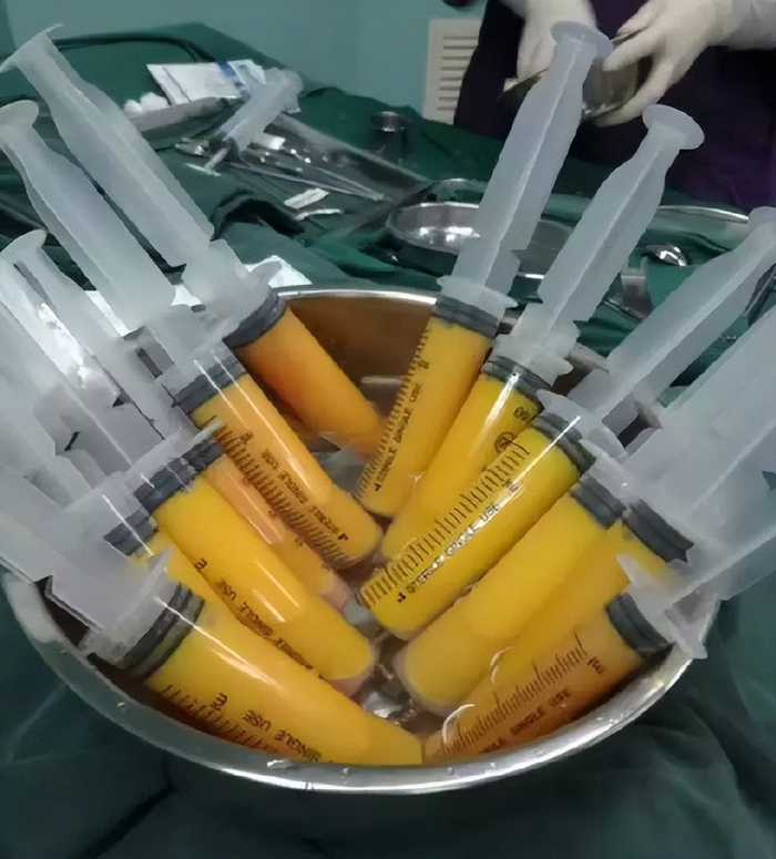 眼部为什么抽脂？