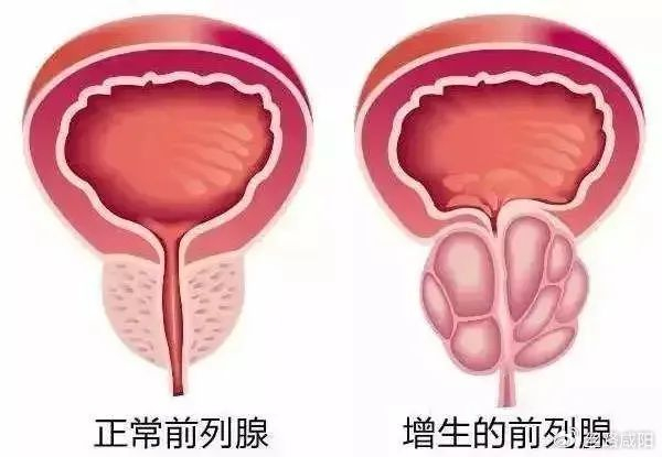 手术放大镜怎么选咸阳市中心医院泌尿外科杜泉:前列腺手术激光时代的践行者_新闻资讯_第2张_活检穿刺产品网 手术放大镜怎么选咸阳市中心医院泌尿外科杜泉:前列腺手术激光时代的践行者_https://www.jmylbn.com_新闻资讯_第2张