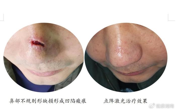 长沙市中心医院：鼻部出现“小坑”，皮肤瘢痕专科门诊来“填坑”