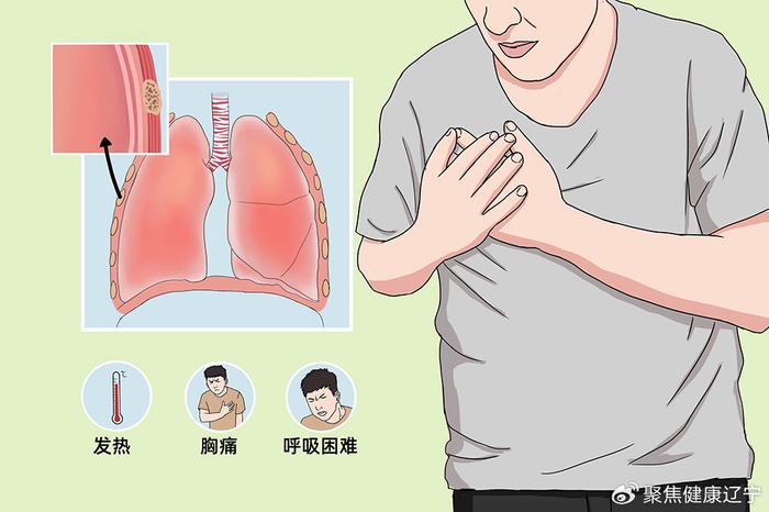 胸膜炎的诱因与治疗