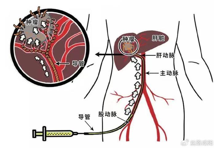 咸阳市中心医院——七旬老人肝肿瘤破裂大出血 微创介入术精准栓塞