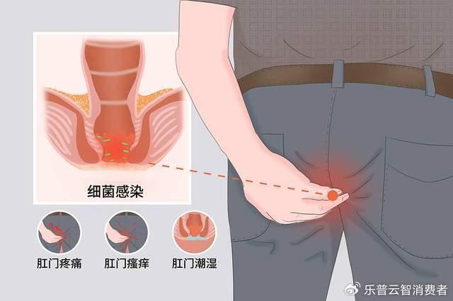 便秘、肛门痛、粪失禁？了解盆底康复在肛肠科的应用