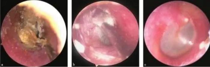 霉菌性外耳道炎症状是哪些成都民生福音耳鼻喉专科医院特色技术效果佳(图2)