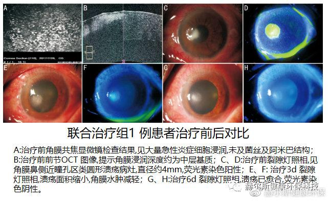 赫尔斯丨次氯酸治疗细菌性和病毒性结膜炎效果显著(图3)