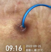 藻酸盐是什么PICC穿刺点红肿渗液持续7月,这样处理效果不错_新闻资讯_第14张_活检穿刺产品网 藻酸盐是什么PICC穿刺点红肿渗液持续7月,这样处理效果不错_https://www.jmylbn.com_新闻资讯_第14张