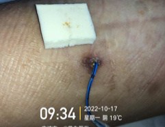 藻酸盐是什么PICC穿刺点红肿渗液持续7月,这样处理效果不错_新闻资讯_第21张_活检穿刺产品网 藻酸盐是什么PICC穿刺点红肿渗液持续7月,这样处理效果不错_https://www.jmylbn.com_新闻资讯_第21张