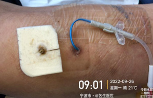 藻酸盐是什么PICC穿刺点红肿渗液持续7月，这样处理效果不错_https://www.jmylbn.com_新闻资讯_第12张