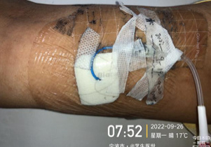 藻酸盐是什么PICC穿刺点红肿渗液持续7月,这样处理效果不错_新闻资讯_第11张_活检穿刺产品网 藻酸盐是什么PICC穿刺点红肿渗液持续7月,这样处理效果不错_https://www.jmylbn.com_新闻资讯_第11张