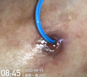 藻酸盐是什么PICC穿刺点红肿渗液持续7月,这样处理效果不错_新闻资讯_第6张_活检穿刺产品网 藻酸盐是什么PICC穿刺点红肿渗液持续7月,这样处理效果不错_https://www.jmylbn.com_新闻资讯_第6张