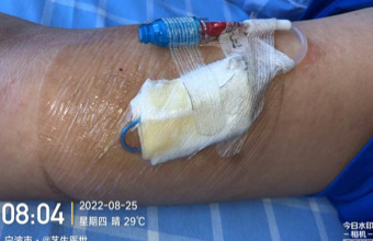 藻酸盐是什么PICC穿刺点红肿渗液持续7月，这样处理效果不错_https://www.jmylbn.com_新闻资讯_第16张