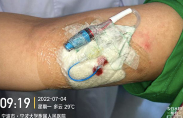 藻酸盐是什么PICC穿刺点红肿渗液持续7月，这样处理效果不错_https://www.jmylbn.com_新闻资讯_第18张