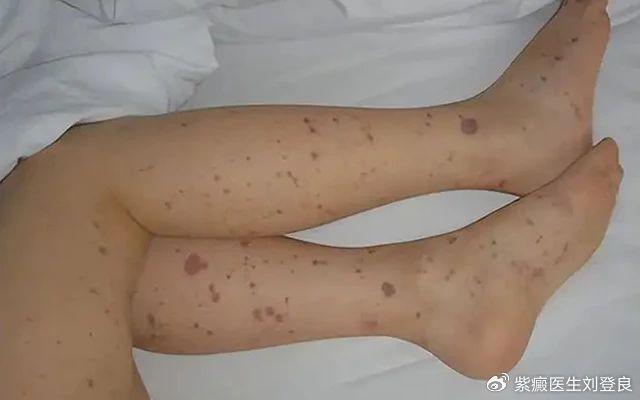 血小板减少性紫癜是什么病？哪几种临床分型？