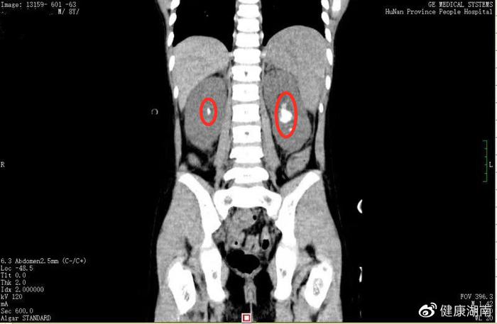 8岁男童术后全泌尿系结石拉不出尿，省医专家不手术不透析巧除石