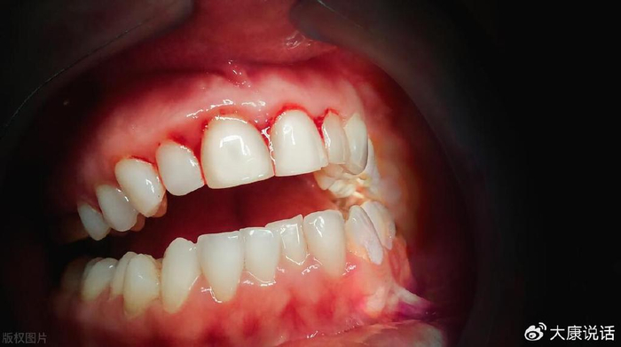 梦境迷离，解析牙龈肿胀、出水、出血与长虫的深层寓意