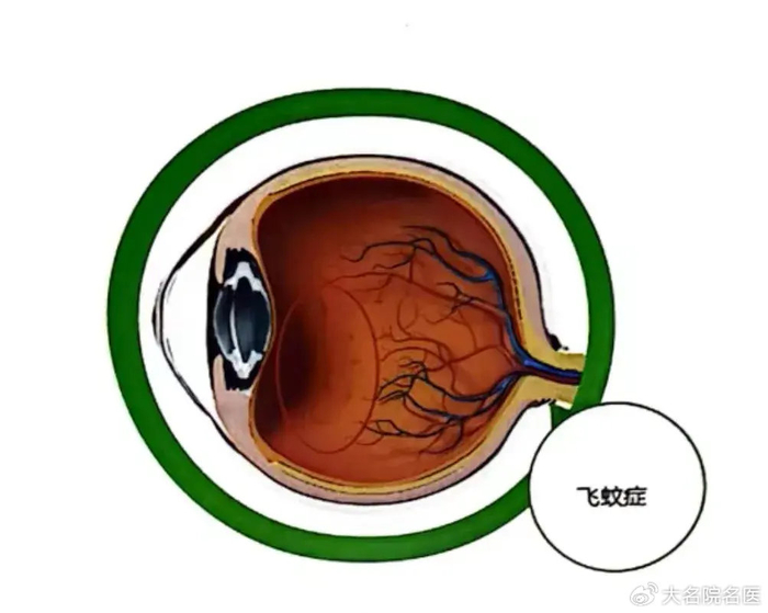 年纪大了，看东西总觉得眼前有黑影飘动（飞蚊症），凝放护眼眼罩可以缓解吗？