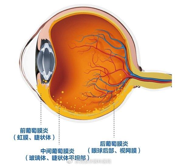 这种“红眼”需警惕——葡萄膜炎(图3)