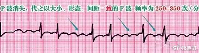 心电图纸有什么规格【干货收藏】教你心电图，没有理由看不懂 ！_https://www.jmylbn.com_新闻资讯_第13张