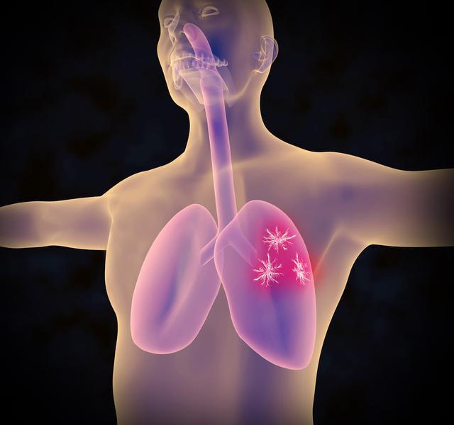 肺癌晚期发热，原因不仅仅是感染，肿瘤自身发热也是常见原因