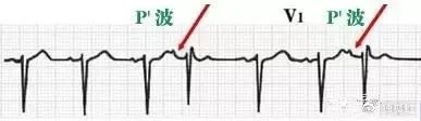 心电图纸有什么规格【干货收藏】教你心电图，没有理由看不懂 ！_https://www.jmylbn.com_新闻资讯_第11张