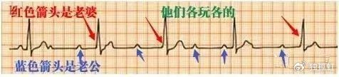 心电图纸有什么规格【干货收藏】教你心电图,没有理由看不懂 !_新闻资讯_第10张_活检穿刺产品网 心电图纸有什么规格【干货收藏】教你心电图,没有理由看不懂 !_https://www.jmylbn.com_新闻资讯_第10张
