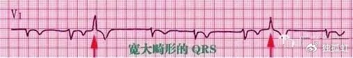 心电图纸有什么规格【干货收藏】教你心电图,没有理由看不懂 !_新闻资讯_第12张_活检穿刺产品网 心电图纸有什么规格【干货收藏】教你心电图,没有理由看不懂 !_https://www.jmylbn.com_新闻资讯_第12张