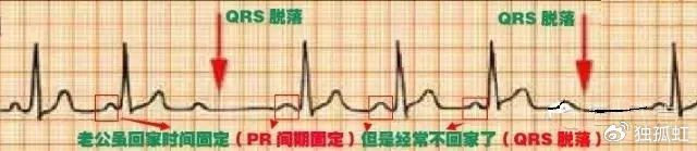 心电图纸有什么规格【干货收藏】教你心电图,没有理由看不懂 !_新闻资讯_第9张_活检穿刺产品网 心电图纸有什么规格【干货收藏】教你心电图,没有理由看不懂 !_https://www.jmylbn.com_新闻资讯_第9张