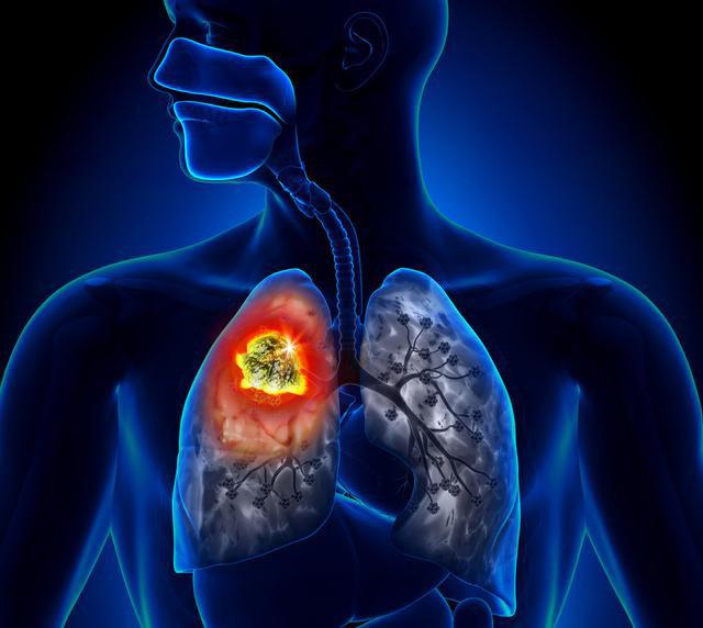 肺癌不治疗会比做治疗活得更久吗？其实有些肺癌已不能算是绝症