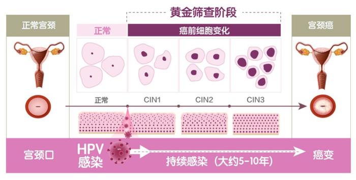 宫颈癌最喜欢的4种女人，别忽视它的早期症状丨癌症专题