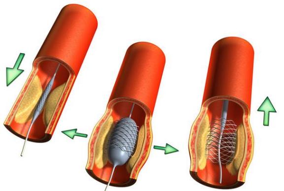 心脏放支架后应该注意什么？医生为你一次性说清