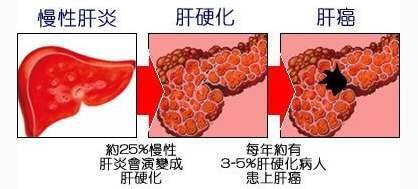 肝病早期无症状？发现4个常见症状，避免肝功能衰退，步入肝硬化