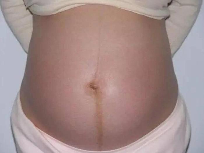 怀孕为什么准妈肚子上会“长毛”？