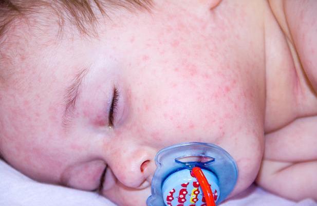 婴幼儿常见的5种皮疹，宝宝到底是哪种？家长如何分辨？