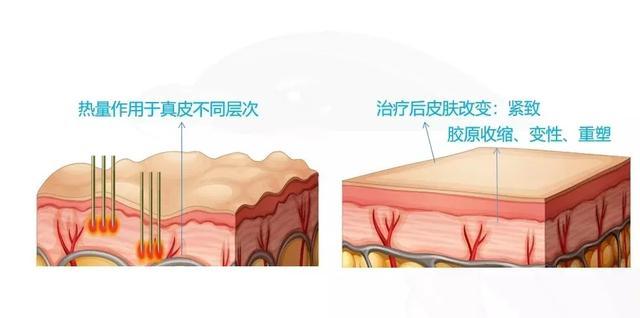 坚持抹橄榄油就能祛除妊娠纹？别逗了