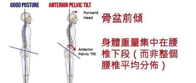 “翘屁股”，我们真的需要它吗？骨盆前倾危害大，9个动作纠正它