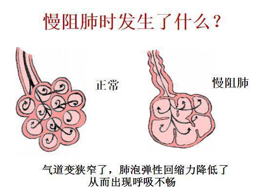 慢支和肺气肿是很遭罪的病，医生提醒：做好6点，咳喘无影踪