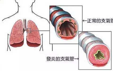 慢支和肺气肿是很遭罪的病，医生提醒：做好6点，咳喘无影踪