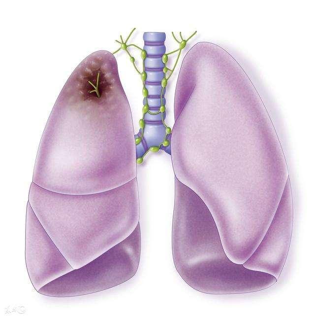 第一癌症肺癌有哪些原因？医生提醒：5项措来预防，5项检查确诊