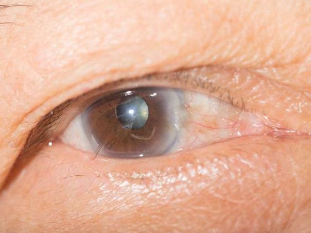 老年人“老眼昏花”就是老花眼？也可能是这3种疾病在作怪